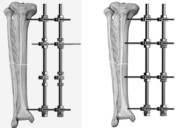 Kết hợp xương điều trị gãy xương là gì?