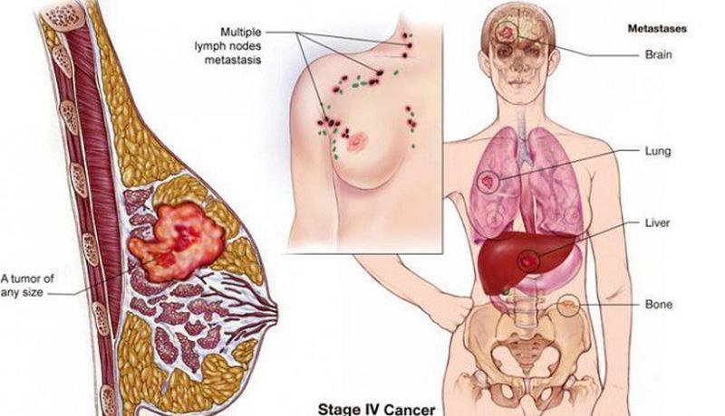 Tế bào ung thư hình thành, phát triển và lan rộng như thế nào?