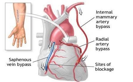 Phẫu thuật bắc cầu động mạch chủ