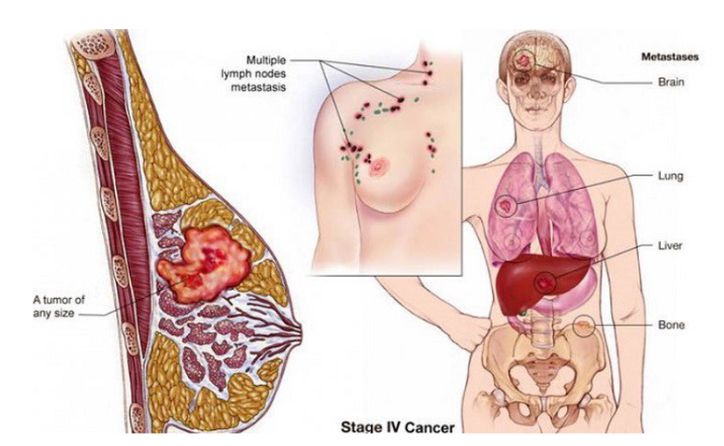 Ung thư gan có thể di căn tới nhiều cơ quan trên cơ thể