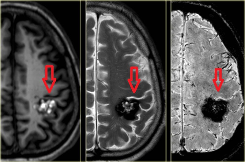 Chẩn đoán bại não bằng kỹ thuật chụp cộng hưởng từ các bó sợi thần kinh