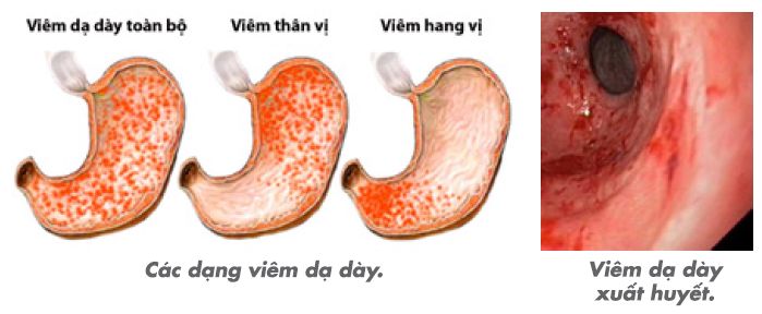 "Thủ phạm" gây xuất huyết dạ dày