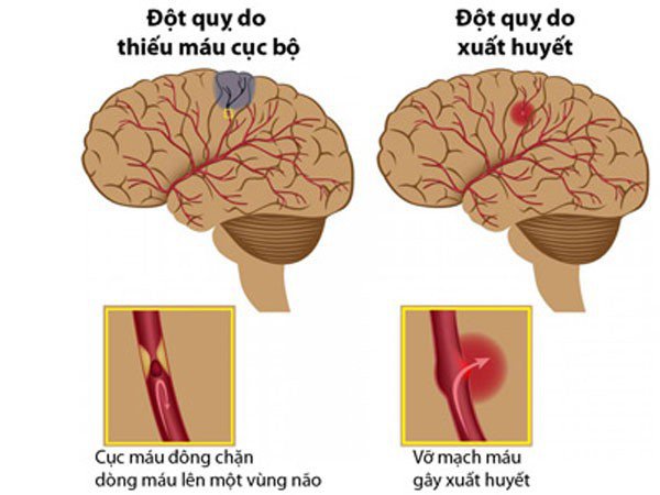 Sự hình thành cục máu đông trong não: Nguyên nhân hàng đầu gây đột quỵ
