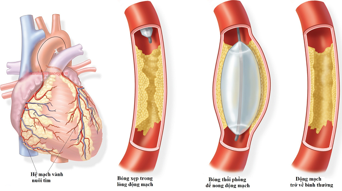 Nhồi máu cơ tim: Khi nào dùng thuốc tiêu sợi huyết, khi nào cần can thiệp?