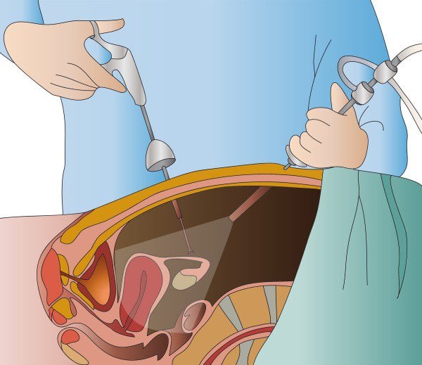 Phẫu thuật nội soi ổ bụng
