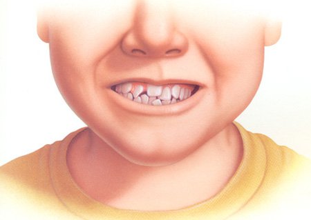 Nguyên nhân và ảnh hưởng của răng mọc chen chúc