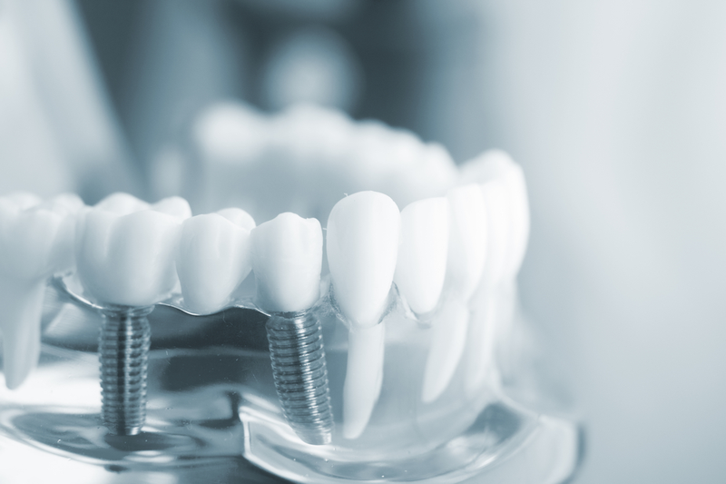 Trồng răng hiện đại (Implant): Giải pháp an toàn cho người bị mất răng