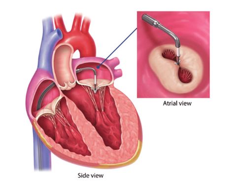 Mitraclip là phương pháp kẹp 2 mép van tim bị hở thành hình số 8