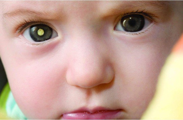 Cách chăm sóc mắt cho trẻ sinh non, phòng bệnh võng mạc