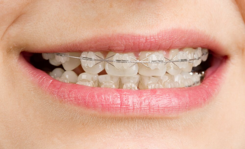 Răng mọc lệch xử lý cách nào?