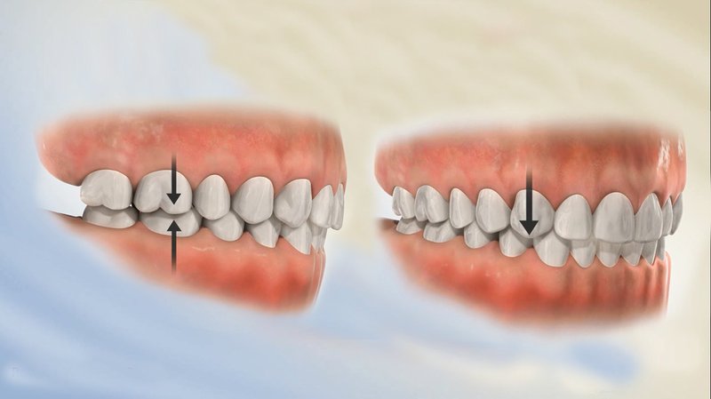 Tác hại và cách điều trị răng lệch khớp cắn