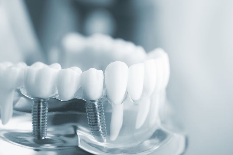 Tiêu xương hàm răng gây ảnh hưởng gì?