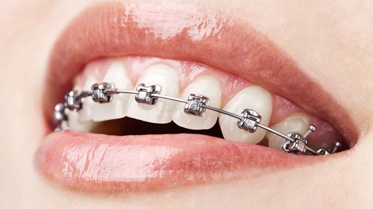 Vì sao niềng răng mắc cài kim loại vẫn được ưa chuộng?
