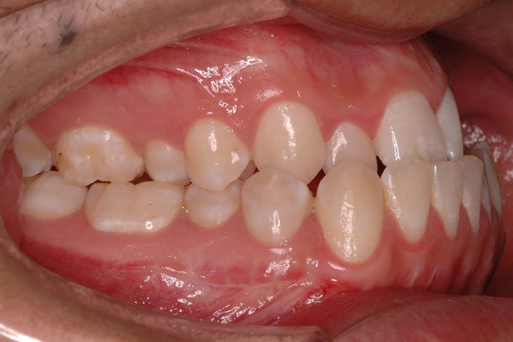 Răng thế nào bị coi là khớp cắn ngược?