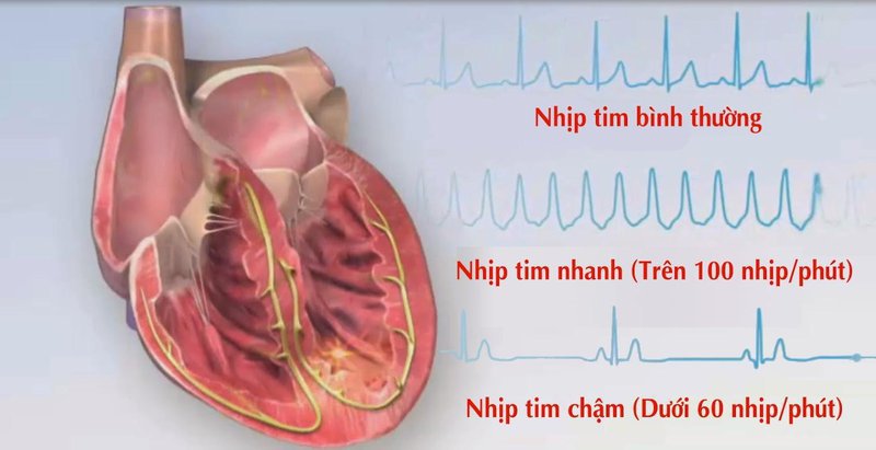 Chẩn đoán và điều trị rối loạn nhịp tim chậm thế nào?