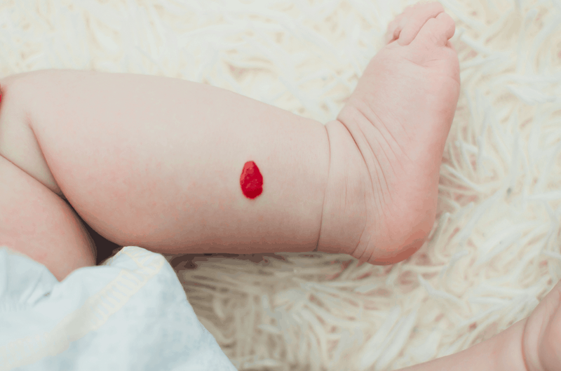 Bướu máu ở trẻ em có nguy hiểm?