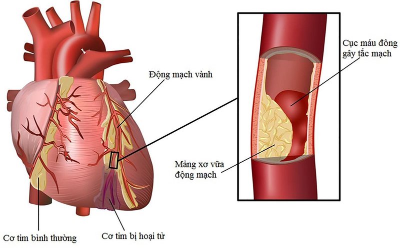 Các giới hạn và nguy cơ bệnh tim mạch do rối loạn lipid máu