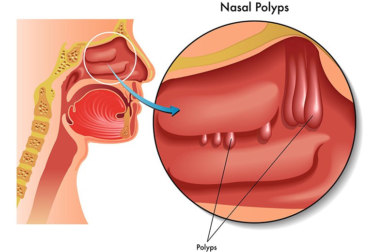 Viêm xoang lâu ngày có thể gây polyp mũi