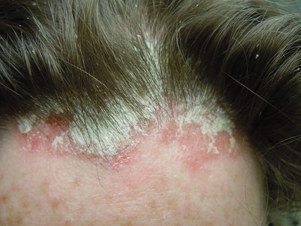 Các bệnh nấm da thường gặp