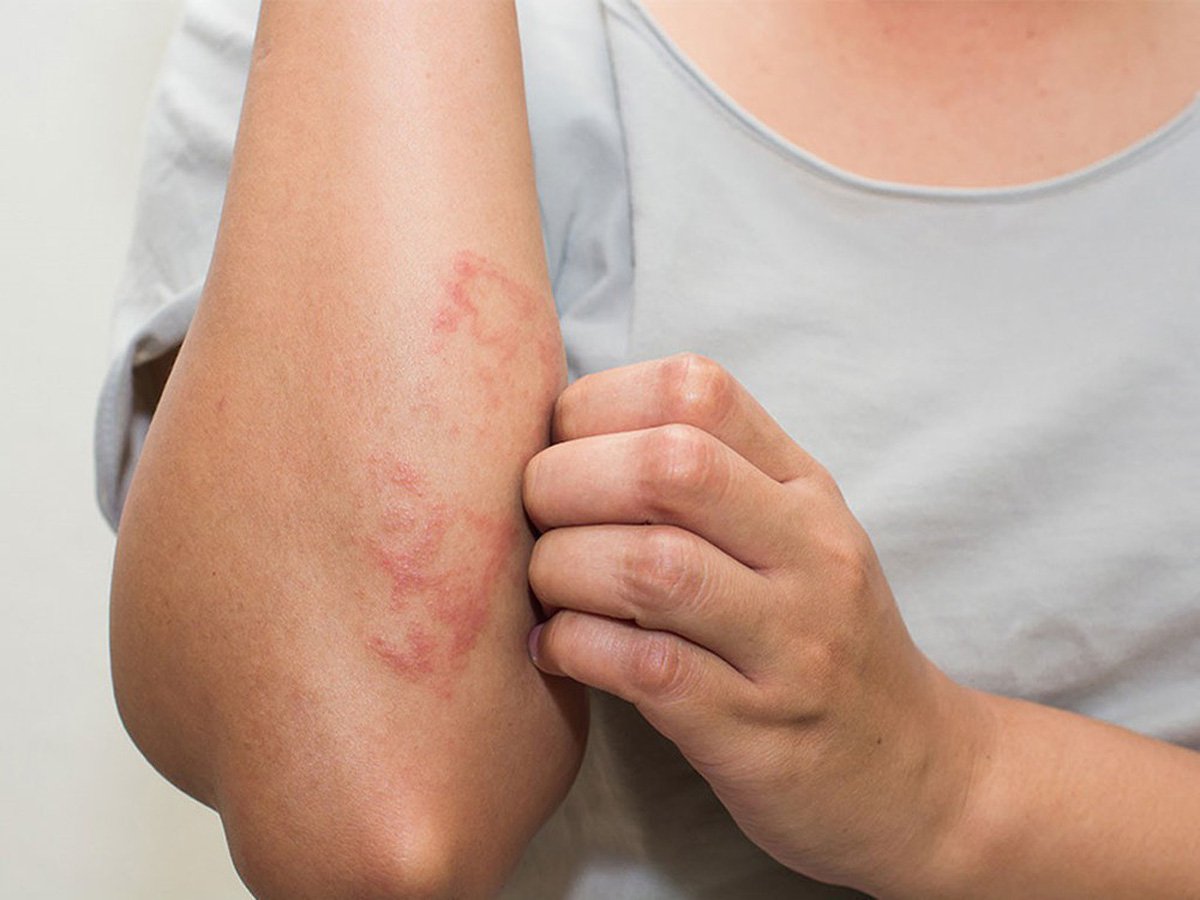 Nguyên nhân và triệu chứng cảnh báo viêm da tiếp xúc