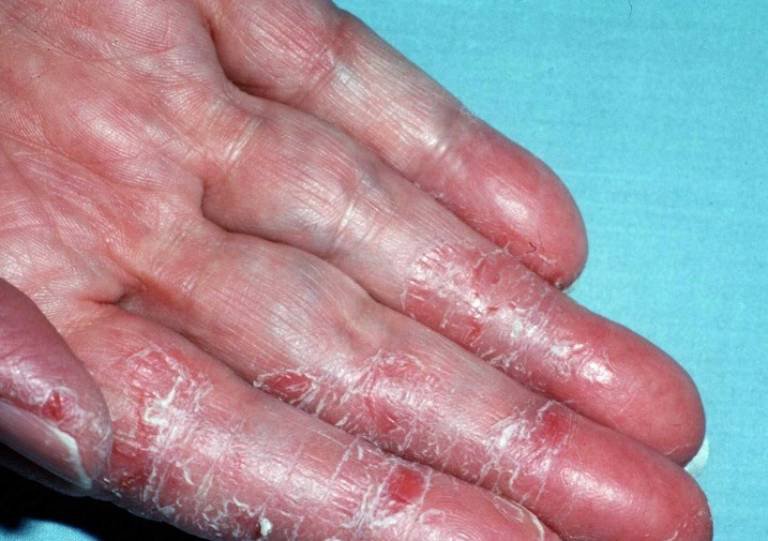 Nguyên nhân và triệu chứng cảnh báo viêm da tiếp xúc