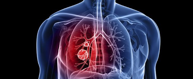 Thế nào là tăng áp động mạch phổi