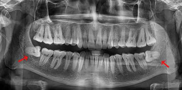 X-quang răng khôn