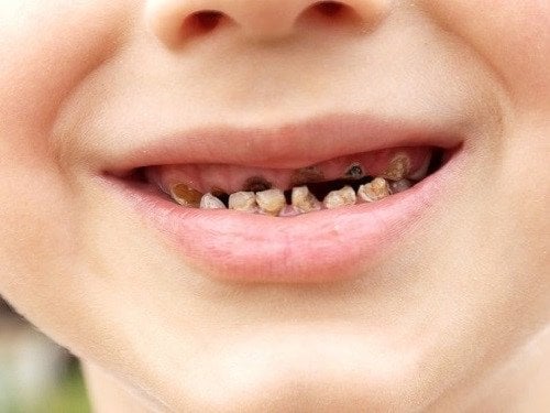 Trẻ 4 tuổi sâu răng hàm