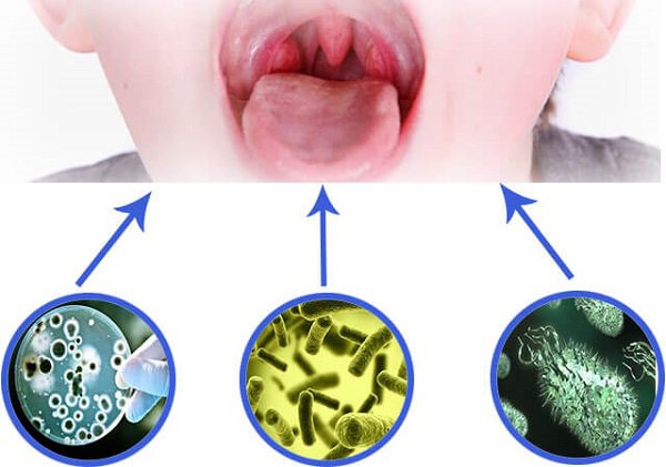 Viêm họng nhiễm khuẩn: Những điều cần biết