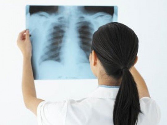 Vai trò của X-quang trong chẩn đoán bệnh khí phế thũng