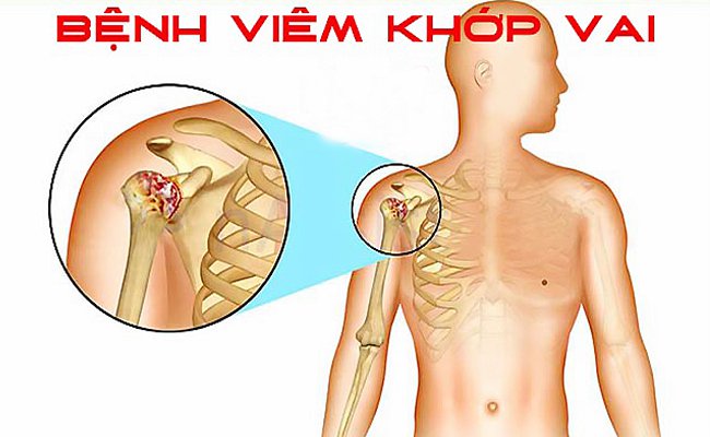 Xquang khớp vai