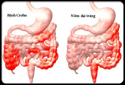 Hội chứng Crohn