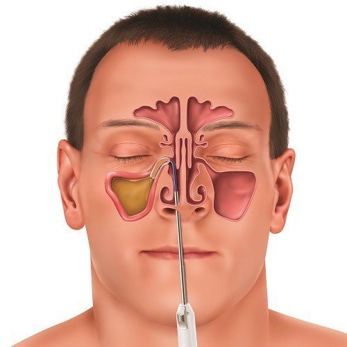 Phẫu thuật nội soi mũi xoang