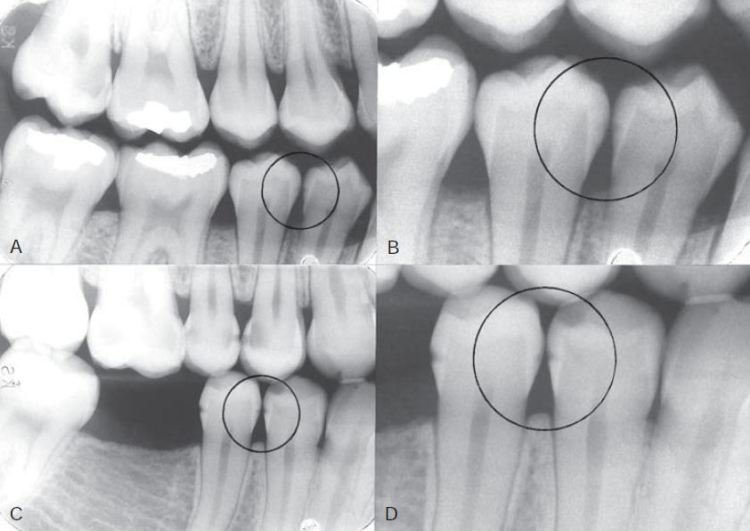 Vai trò của chụp X quang răng