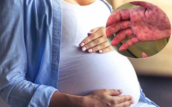 Phụ nữ mang thai mắc tay chân miệng