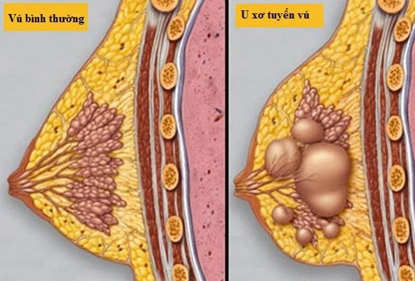 U xơ tuyến vú