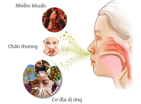 Nguyên nhân gây bệnh viêm mũi dị ứng