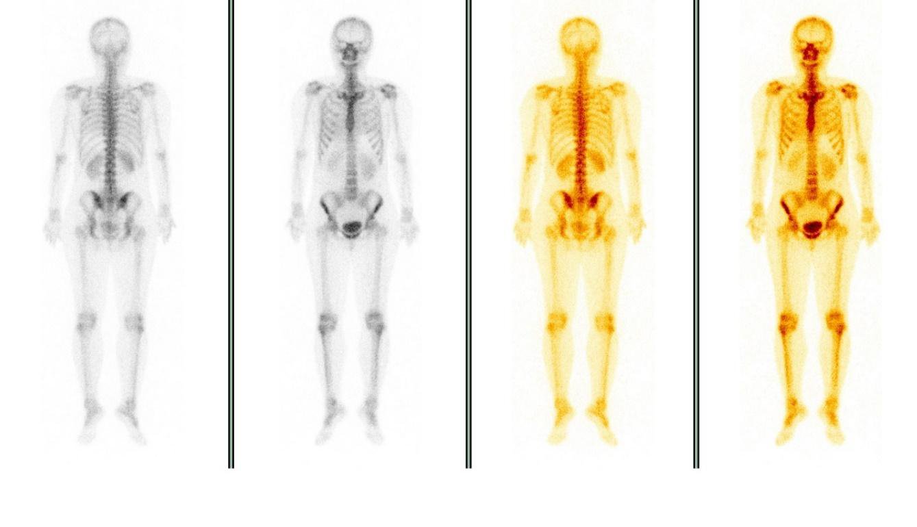 Hình ảnh xạ hình xương ở người bình thường