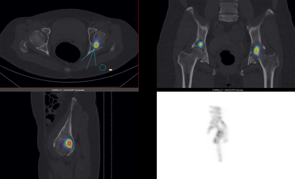 Hình ảnh tổn thương ở khớp háng bên trái và trần khớp háng bên phải phát hiện trên SPECT/CT