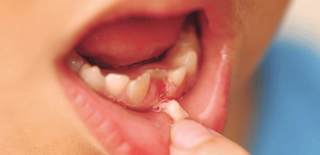 Trẻ bắt đầu thay răng sữa khi 5 - 6 tuổi