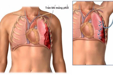 Một số điều cần biết về đặt ống dẫn lưu màng phổi
