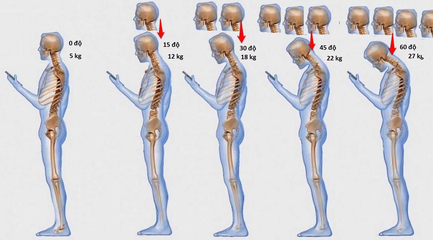 Vì sao điện thoại thông minh lại gây đau xương khớp?