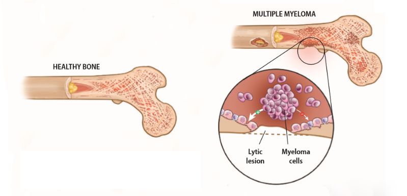 Đa u tủy xương myeloma