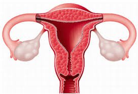 Dính buồng tử cung thường xảy ra trong tình huống nào?