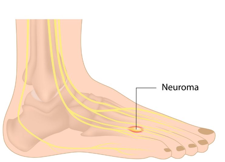 U dây thần kinh Moron gây tê bì ngón chân