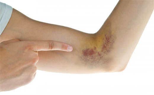 Vết bầm tím kèm xuất huyết tự nhiên xuất hiện trên da, có đáng ngại?