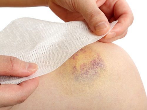 Vết bầm tím kèm xuất huyết tự nhiên xuất hiện trên da, có đáng ngại?