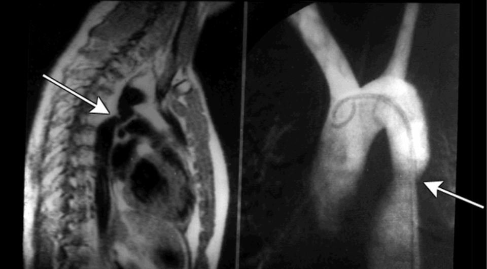 Chẩn đoán hẹp eo động mạch chủ -X-quang