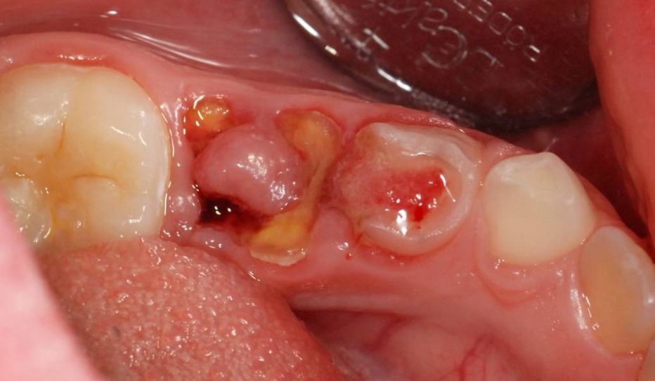 U men răng - Ameloblastoma