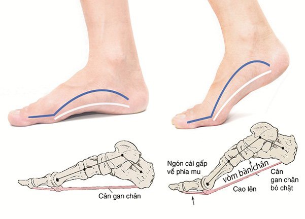 Sơ đồ hình vòm lòng bàn chân: Cân gan chân (Xanh); vòm xương (Cam)